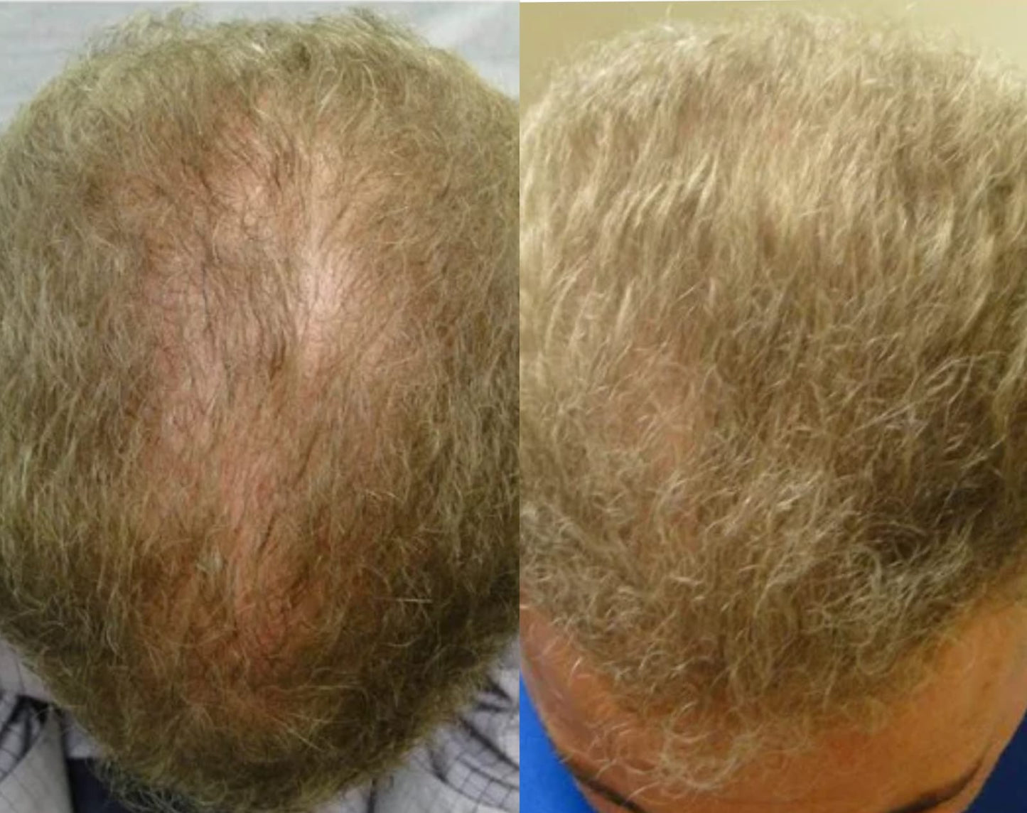 Lustrao Hair regrowth oil-4